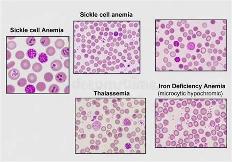 Secuencia de imágenes microscópicas que muestran el desarrollo de los hematoides desde el día 2 hasta el día 14, con la aparición de manchas rojas de sangre
