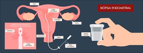 Comparación de la arquitectura celular de un endometrio artificial con una biopsia de tejido endometrial humano