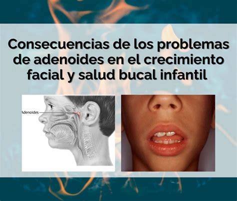 Representación de adenoides hipertróficas obstruyendo las vías respiratorias superiores de un niño