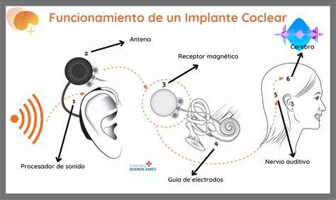 Diagrama de cómo funciona un implante coclear, mostrando sus componentes y la vía de estimulación auditiva
