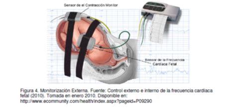 Infografía detallando el funcionamiento de un cardiotocógrafo y la monitorización fetal