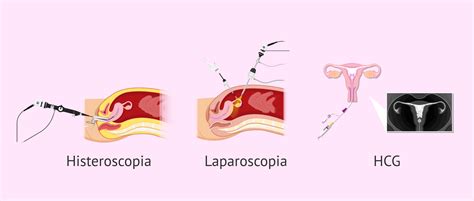 Esquema comparativo entre legrado y histeroscopia