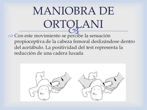 Ilustración de las maniobras de Ortolani y Barlow.