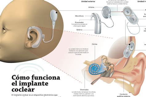 Infografía comparativa sobre dispositivos de asistencia: audífonos vs. implantes cocleares