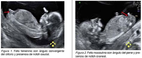 Esquema de las tecnologías utilizadas para la determinación del sexo fetal