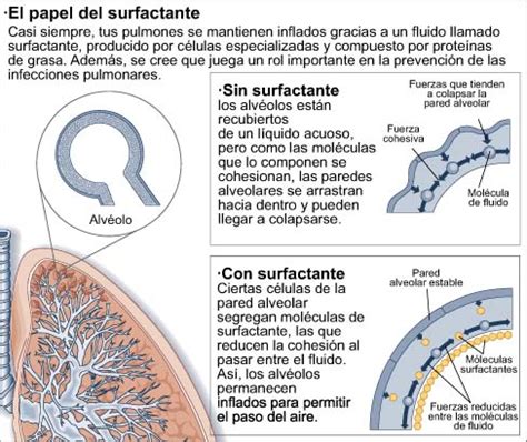 Diagrama explicativo sobre el papel del surfactante en los pulmones de un bebé prematuro.
