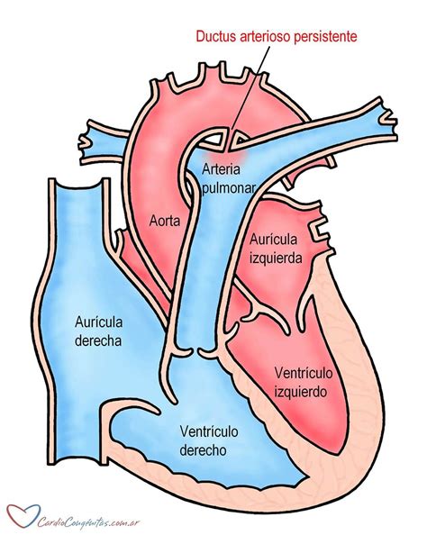 Esquema del corazón fetal con el ductus arterioso persistente