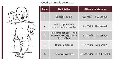 Esquema del Índice de Kramer con las diferentes zonas de distribución de la ictericia en el cuerpo del recién nacido