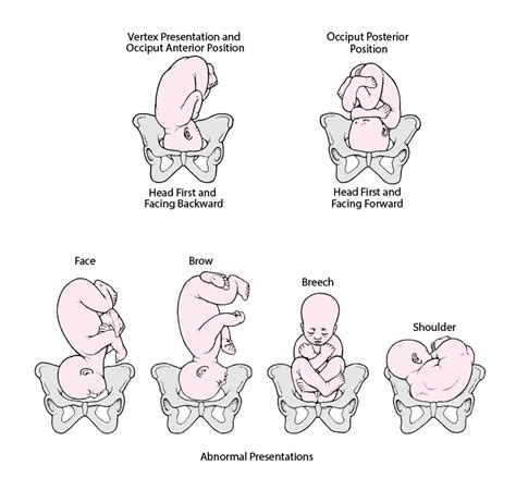 Diagrama de presentación occipitoposterior fetal