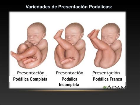 Ilustración de presentación podálica franca, completa e incompleta
