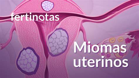 Ilustración comparativa entre un útero sano y uno con presencia de miomas o endometriosis.