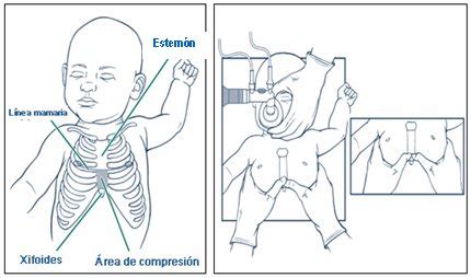 Ilustración de la técnica de masaje cardíaco neonatal con dos pulgares