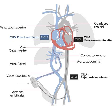 Diagrama mostrando la inserción de un catéter venoso umbilical