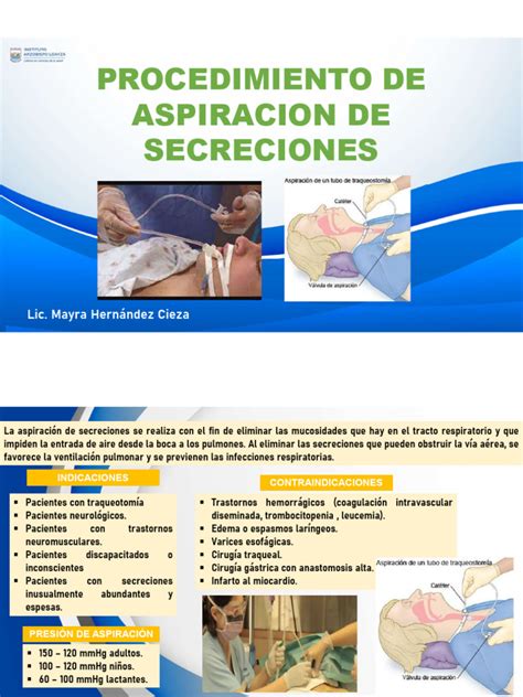 Esquema explicativo del procedimiento de aspiración manual por vacío en el primer trimestre
