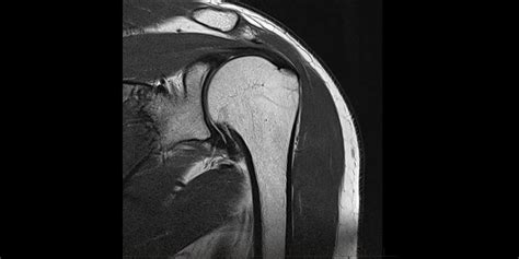 Primer plano de un manguito neonatal con marcadores de tamaño y línea de índice claramente visibles.