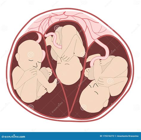 Ilustración de un útero con múltiples fetos, representando una gestación múltiple.