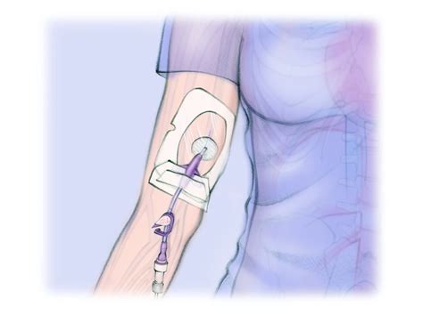 Esquema anatómico de la inserción de un catéter PICC en un neonato, mostrando el recorrido desde la vena periférica hasta la vena cava superior o inferior.