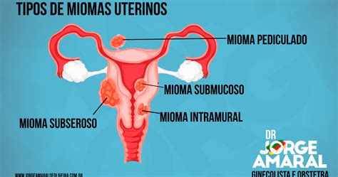 Ilustración detallada de los diferentes tipos de miomas uterinos (submucoso, intramural, subseroso) y su localización.