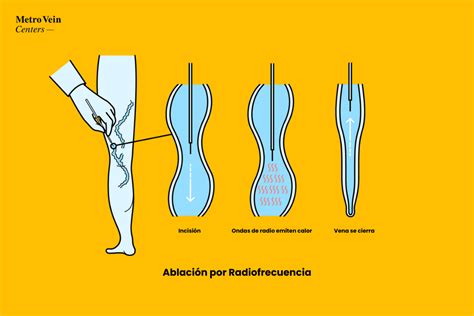 Infografía comparativa de la ablación por radiofrecuencia frente a la cirugía tradicional para miomas, destacando invasividad, tiempo de recuperación y riesgos.