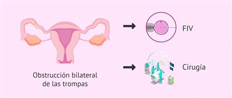Diagrama que muestra la reconstrucción de las trompas de Falopio en una cirugía de reversión.