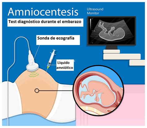 Esquema de una amniocentesis mostrando la aguja en el saco amniótico