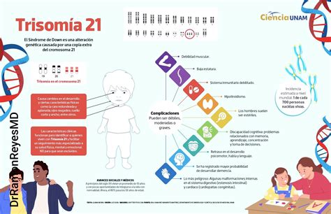 Representación esquemática del cromosoma 21 y la trisomía 21.