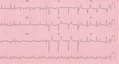 Electrocardiograma (ECG) que muestra un bloqueo aurículo-ventricular completo, con disociación auriculoventricular.