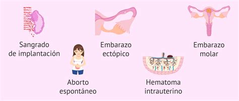 Infografía sobre los tipos de sangrado en el primer trimestre