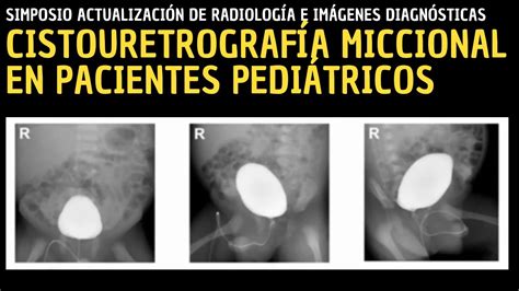 Ilustración de un niño siendo preparado para una cistouretrografía miccional, mostrando el equipo médico.