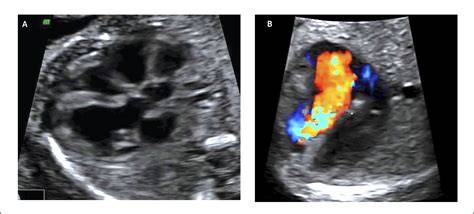 Ecografía fetal que muestra el corazón del feto con enfoque en las válvulas