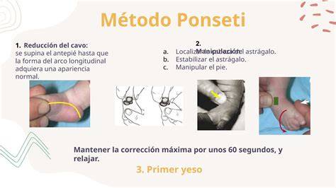 Infografía del Método Ponseti paso a paso