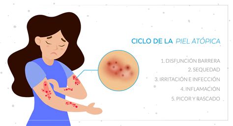 Gráfico ilustrativo del ciclo vicioso prurito-rascado en dermatitis atópica.