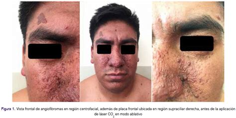 Fotografía de un rostro con angiofibromas faciales característicos de la esclerosis tuberosa