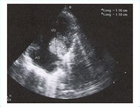 Imagen ecocardiográfica mostrando un rabdomioma cardíaco