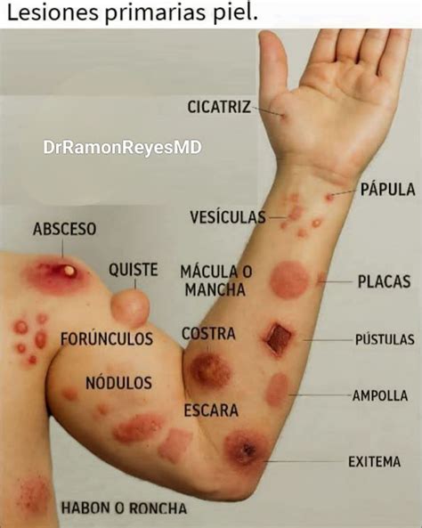 Ilustración de la evolución de las lesiones cutáneas de la varicela