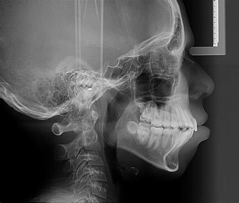 Foto de detalle de patología en cráneo infantil recuperado en el barrio de la Lagunilla, Ciudad de México