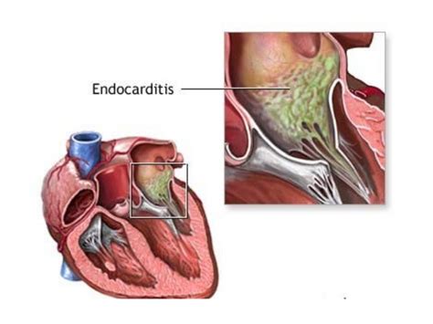 Imágenes de lesiones cardíacas por endocarditis valvular en cerdos
