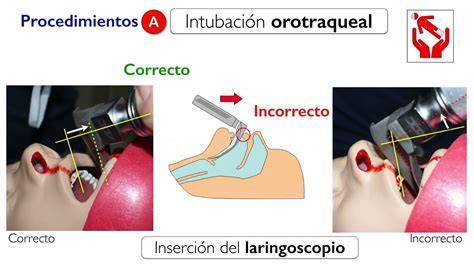 Esquema detallado del proceso de intubación orotraqueal y posicionamiento del tubo en la tráquea