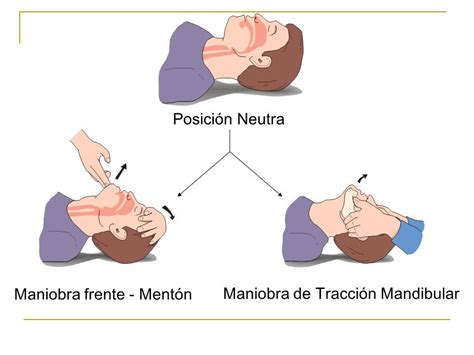 Ilustración de la maniobra frente-mentón para abrir la vía aérea