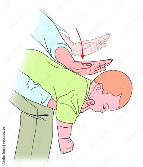 Ilustración de la maniobra de Heimlich en niños