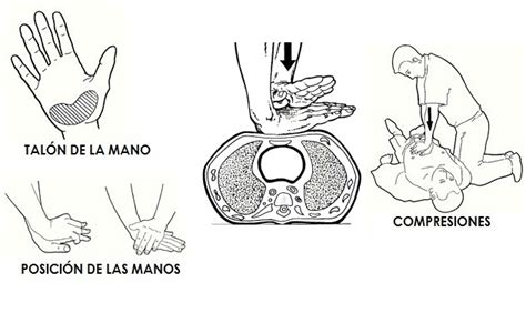 Ilustración de la técnica de masaje cardíaco con dos dedos en lactantes