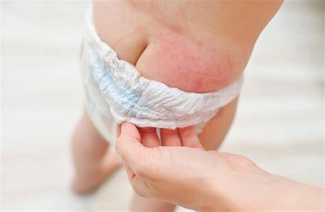 Foto de la piel con candidiasis del pañal