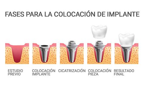 Esquema que muestra las fases de preparación para un implante dental: desde la historia clínica hasta la planificación digital y los análisis de laboratorio.