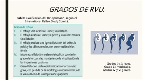 Diagrama de la clasificación de grados del reflujo vesicoureteral (I a V)