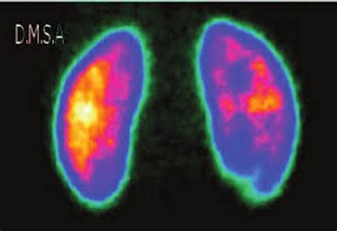 Imagen de gammagrafía con DMSA mostrando cicatriz renal