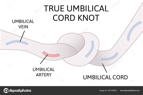 Esquema del cordón umbilical con un nudo verdadero