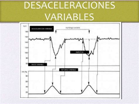 Gráfica de cardiotocografía mostrando desaceleraciones variables y tardías