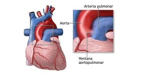 Esquema anatómico mostrando la conexión entre la aorta y la arteria pulmonar que constituye el ductus arterioso.