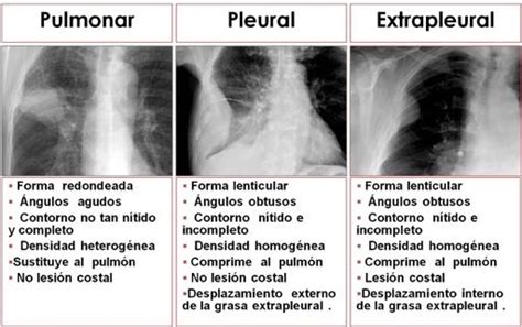 Diagrama comparativo de las técnicas quirúrgicas transpleural y extrapleural en neonatos.