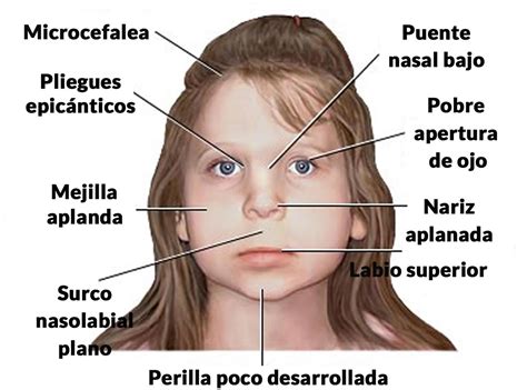 Ilustración detallada de los rasgos faciales característicos del Síndrome Alcohólico Fetal.